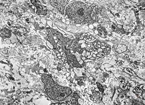 F,12y. | malignant tumor of the orbita - liposarcoma?, neurofibrosarcoma?